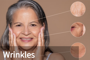 Wrinkles